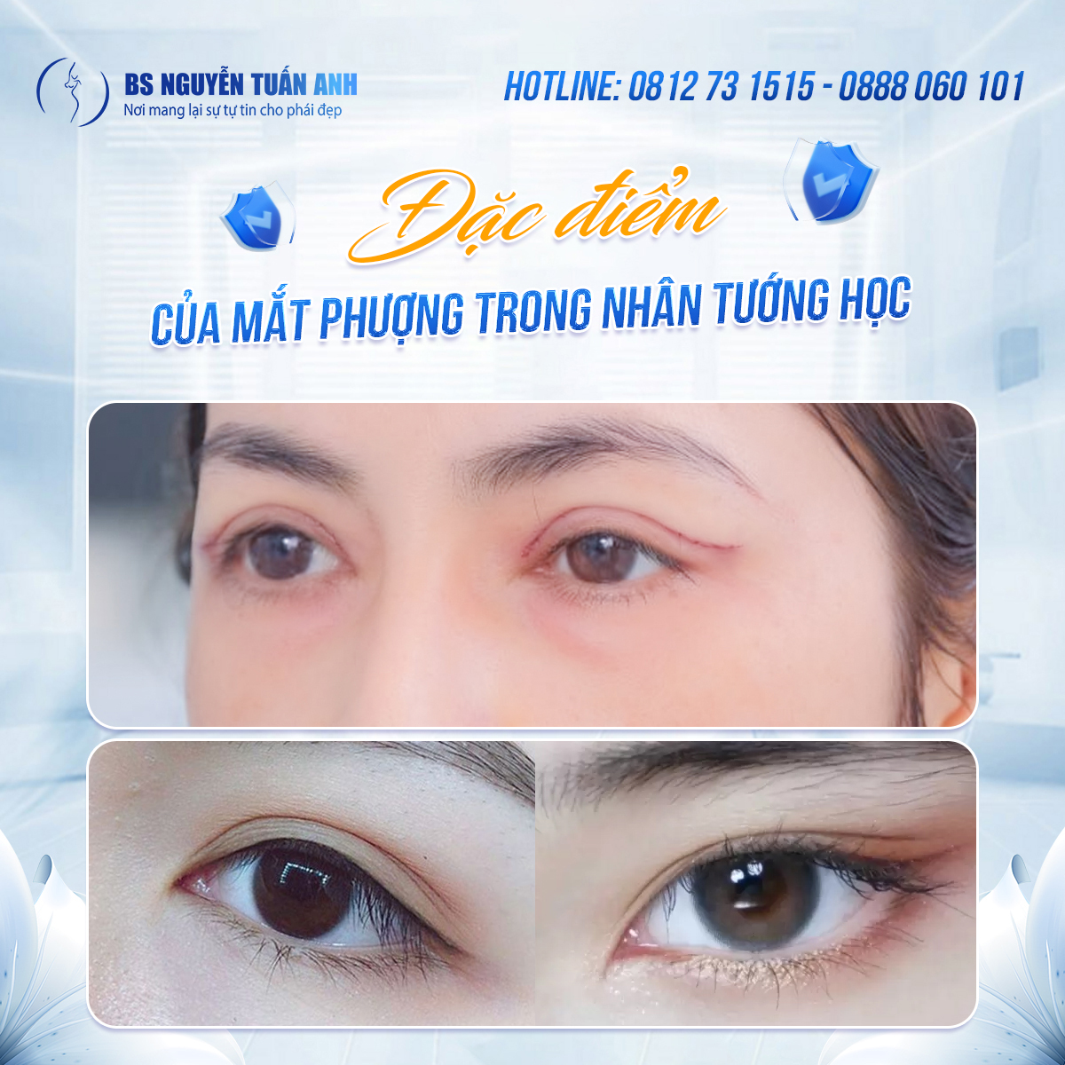 Cắt mí phượng có cải thiện tướng số không