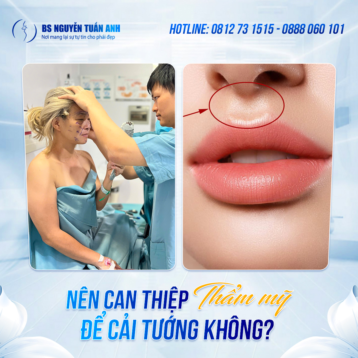 Nhân trung sâu dài nói lên điều gì